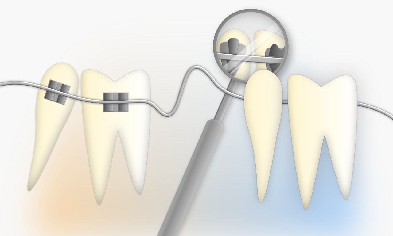 Unauffällige Zahnspangen